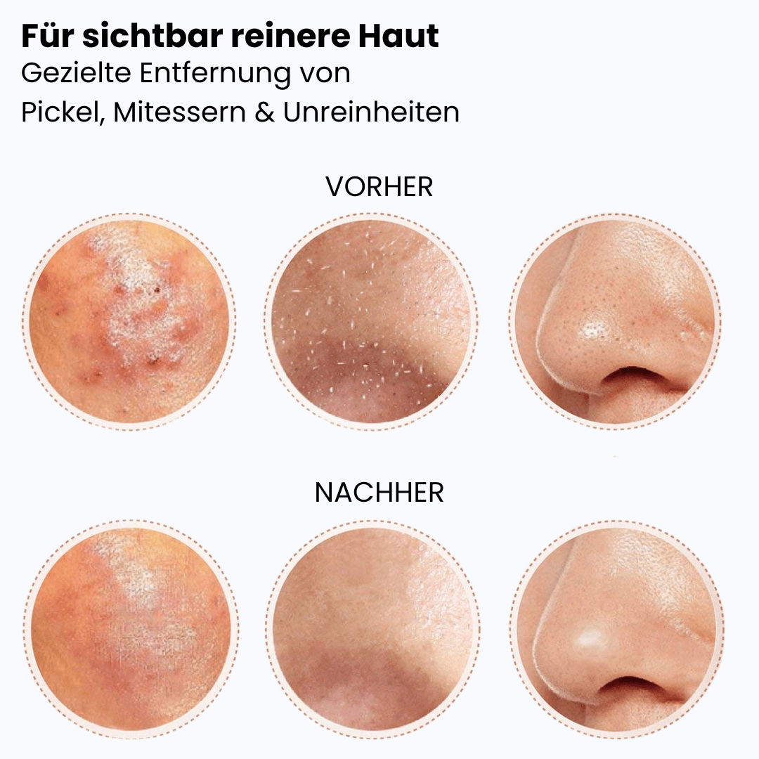 Mitesserentferner & Komedonen-Set