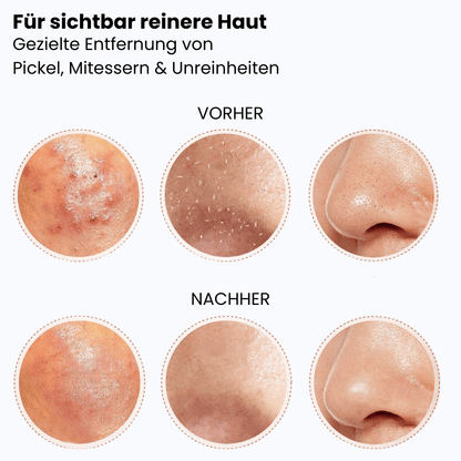 Mitesserentferner & Komedonen-Set